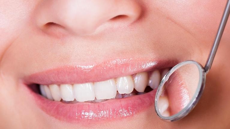 Dental Veneers in Encinitas CA