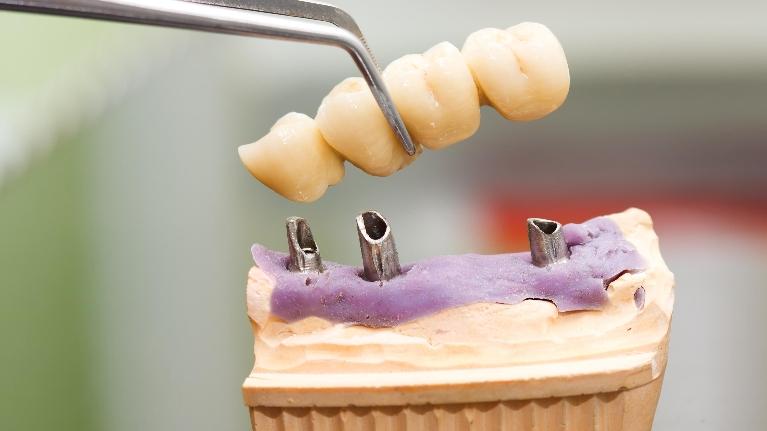 Dental Bridges in Encinitas CA