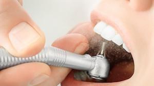 Silver Filling Replacements Encinitas CA