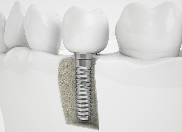 Dental Implants in Encinitas CA