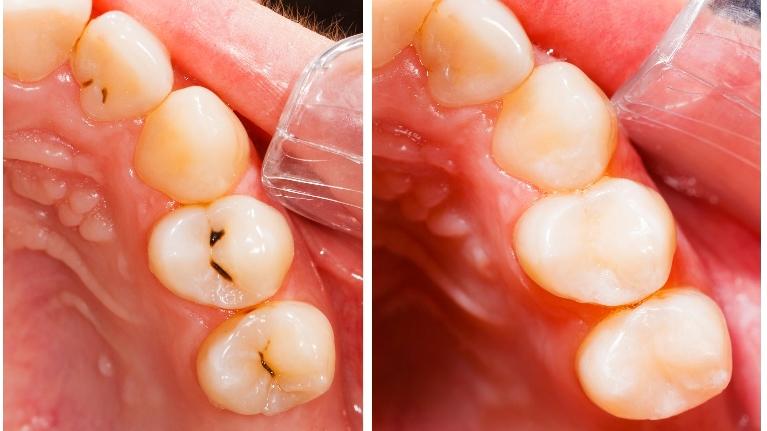 Treatment for Dental Decay Encinitas CA