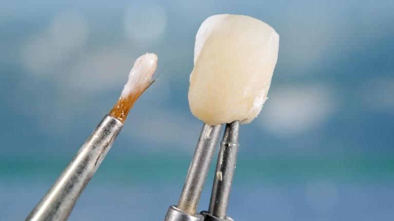 Dental Crowns Encinitas CA