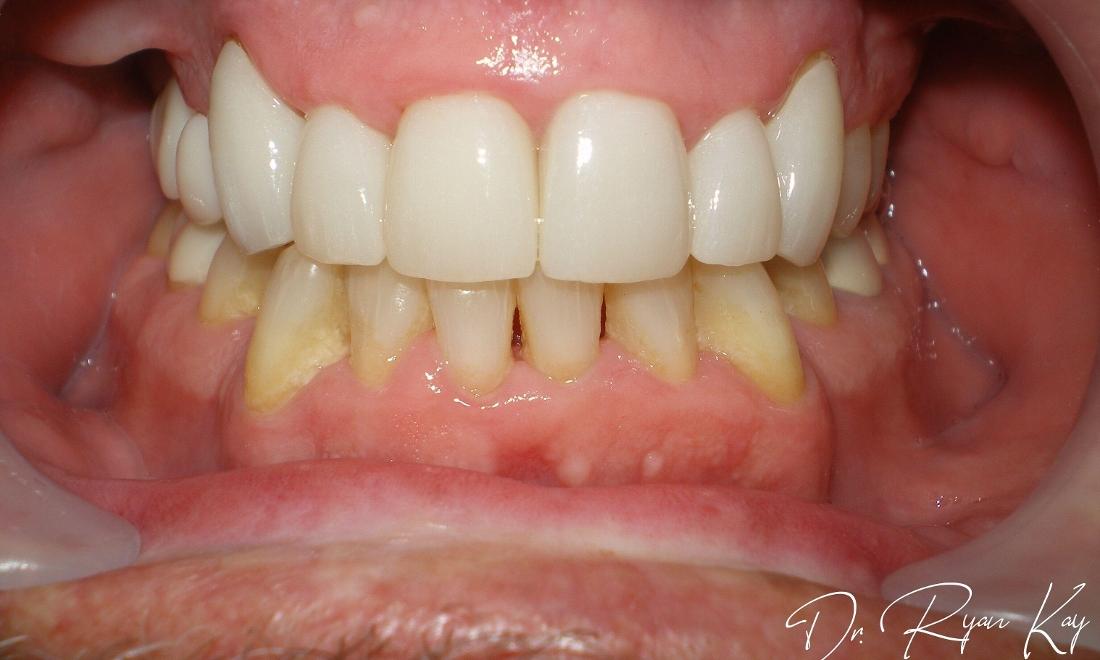 After photo- Crown work