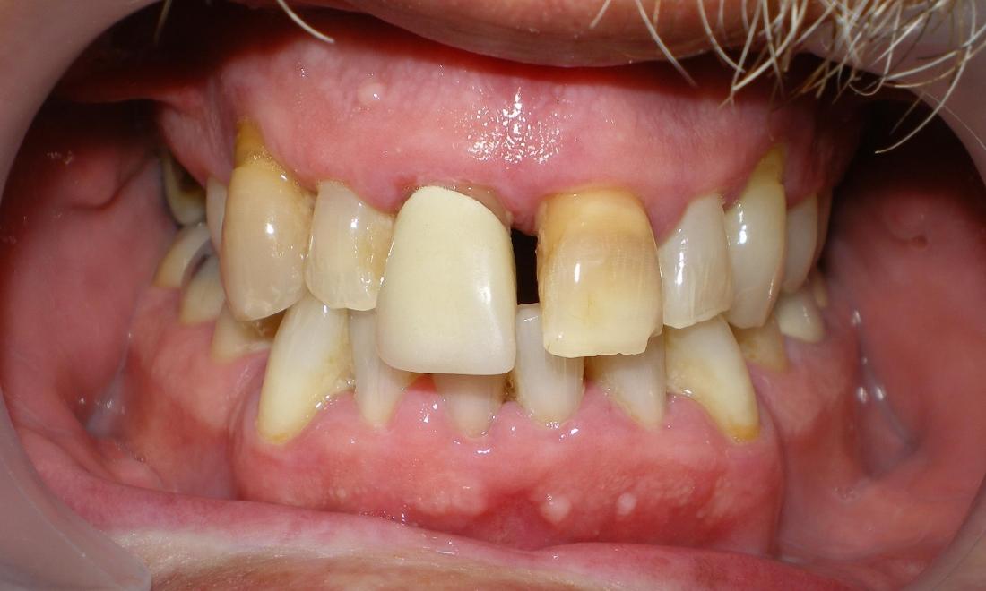 Before photo, crown work