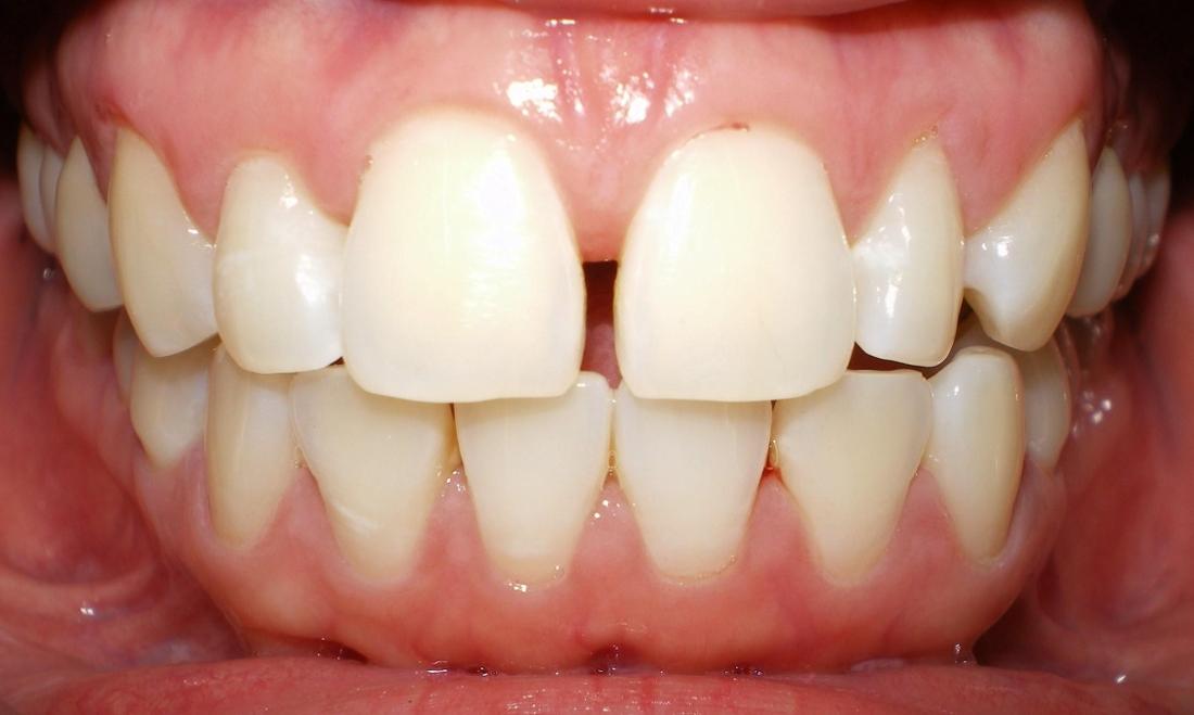Before photo, veneers case