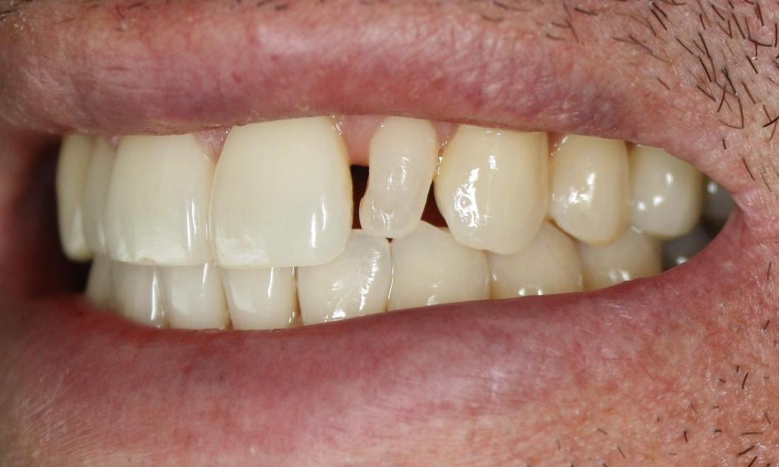 Before photo, Veneer work