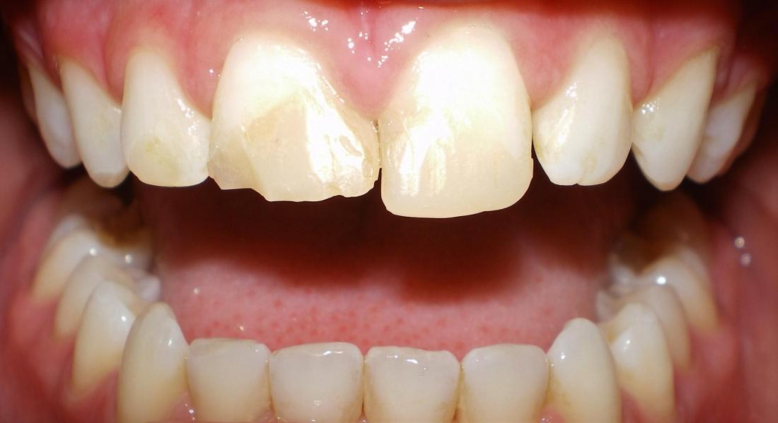 Before photo, Veneer work