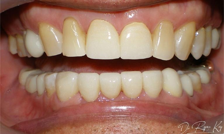 After photo- Crown work