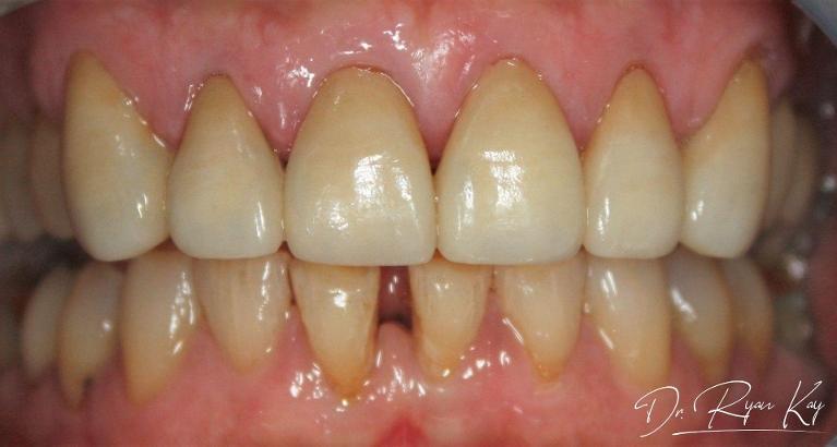 After photo- Crown work