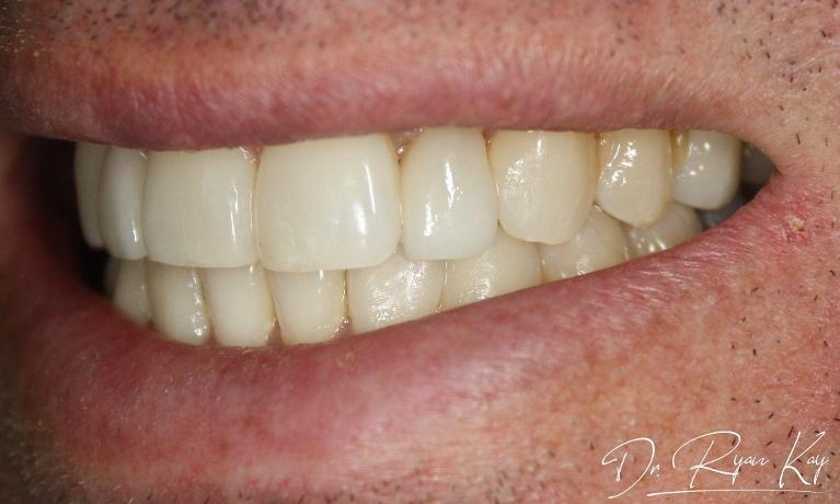 after photo, veneers case