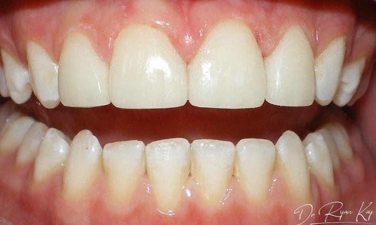 after photo, veneers case