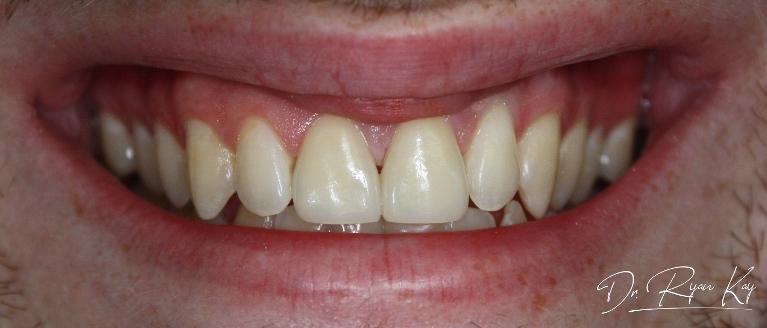 after photo, veneers case