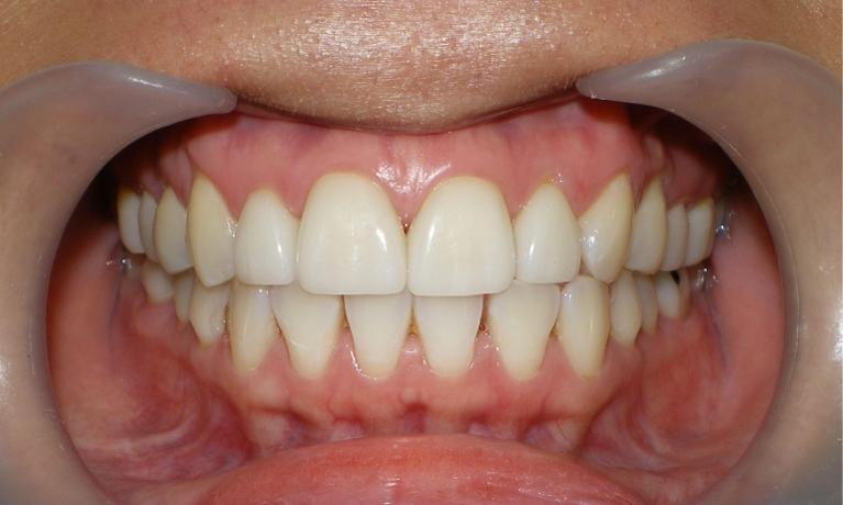 Veneers-After-Image