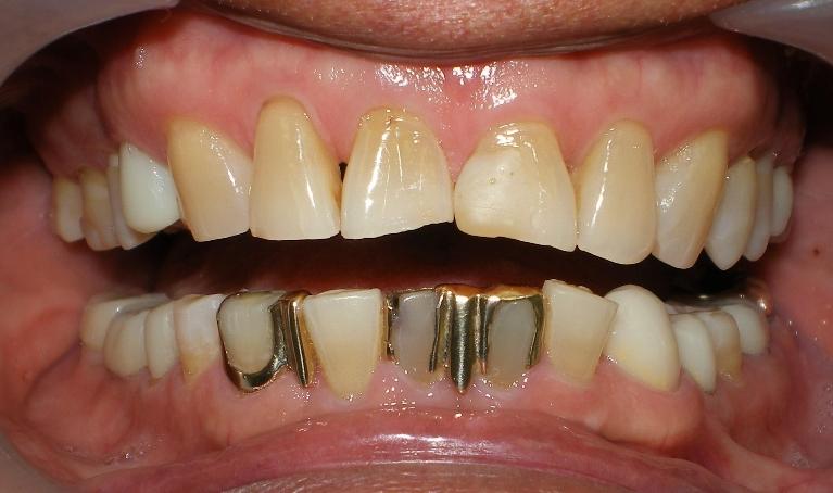 Before photo, crown work