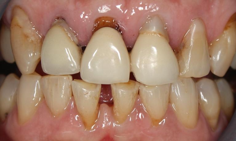 Before photo, crown work