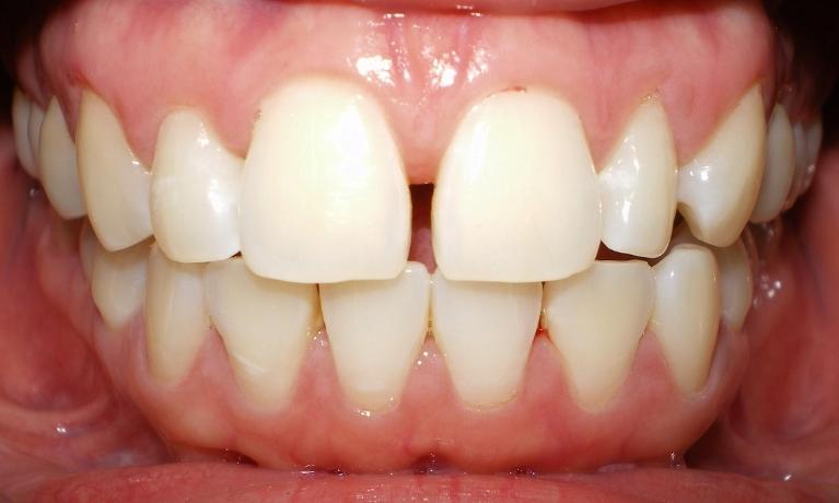 Veneers-Before-Image
