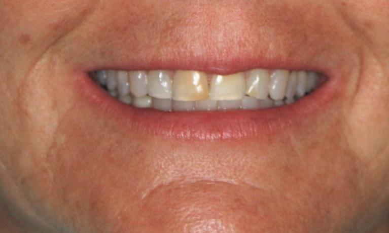 Veneers-Before-Image