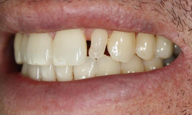 Before photo, Veneer work