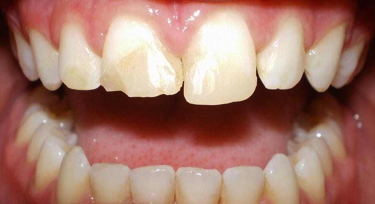 Before photo, Veneer work