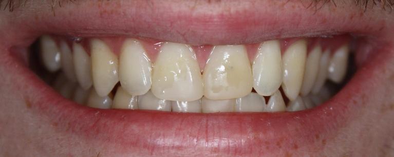 Before photo, Veneer work